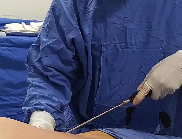 liposuccion