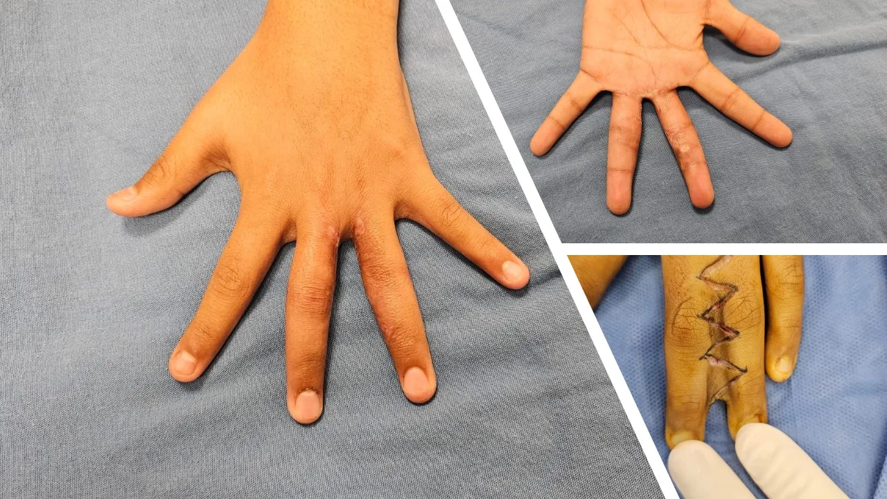 Tratamiento-de-mano-congenita