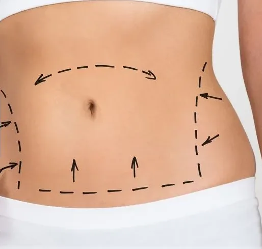 Abdominoplastía