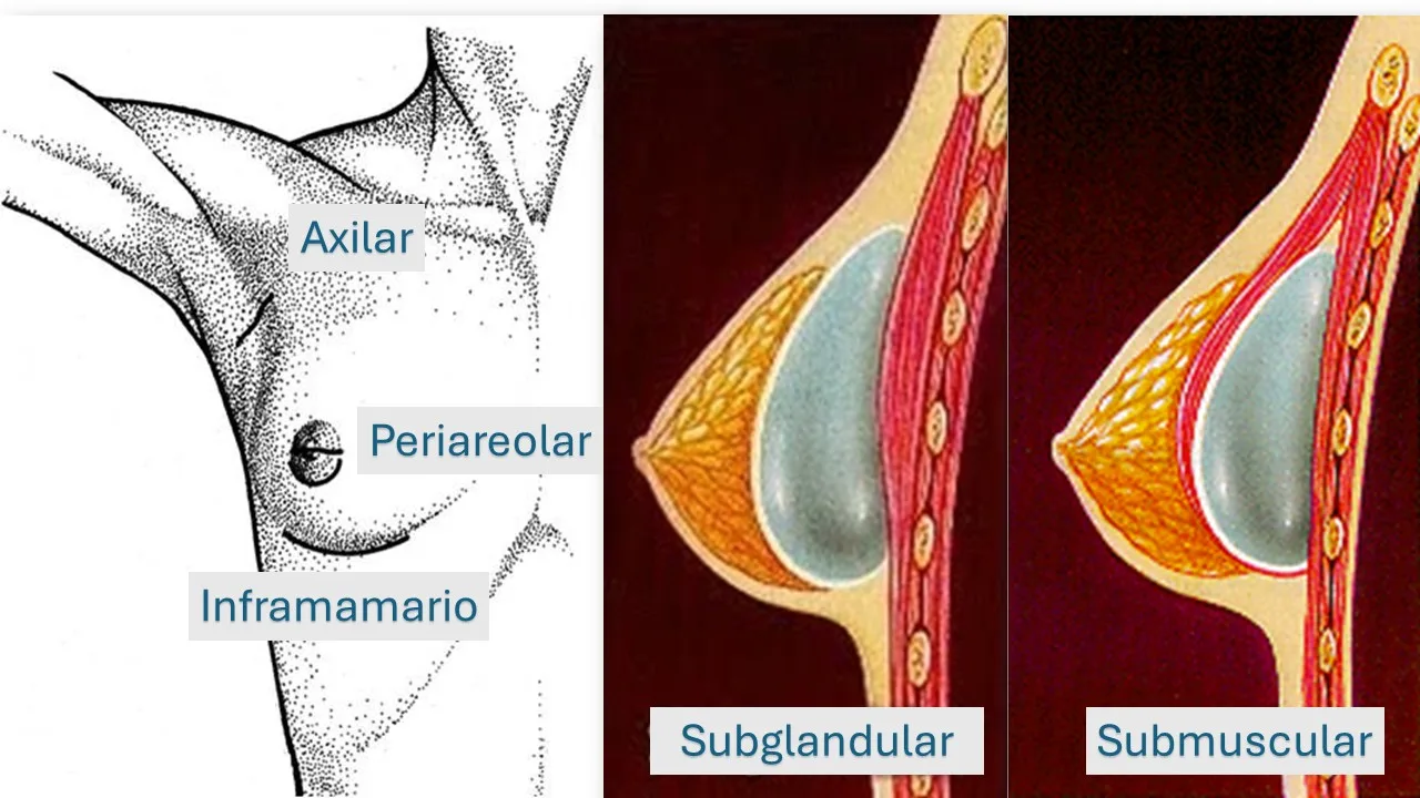 incision-y-plano-aumento-mamario