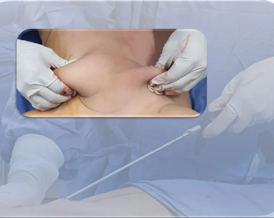 liposucción