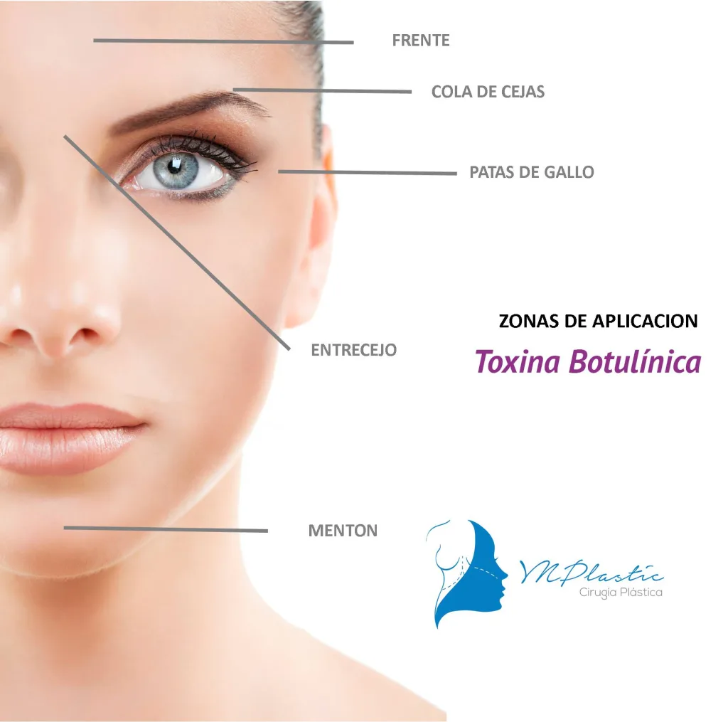 Sitio-de-aplicacion-de-tocina-botulinica