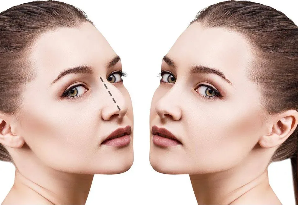 rinoplastia
