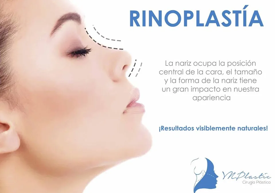 Rinoplastía