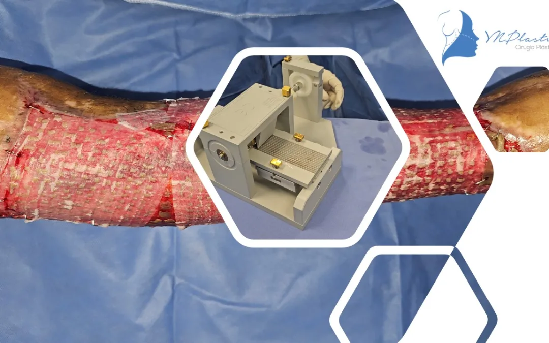 Microinjertos Meek: Innovación en el Tratamiento de Grandes Quemaduras y Pérdida de Tejido